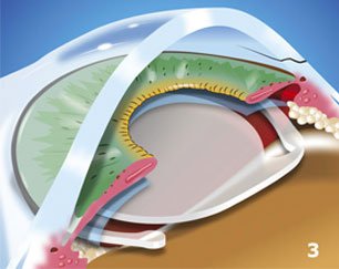 obati katarak obati katarak