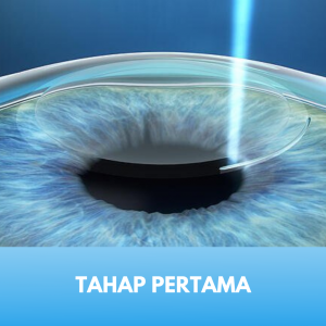 Laser Femtosecond Tahap 1