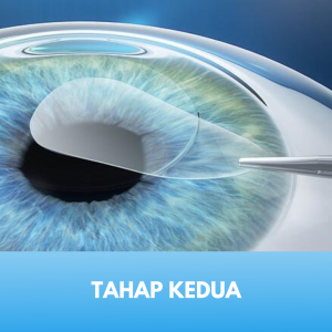 Laser Femtosecond Tahap 2