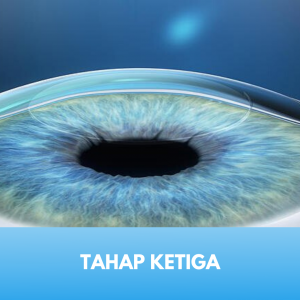 Laser Femtosecond Tahap 3