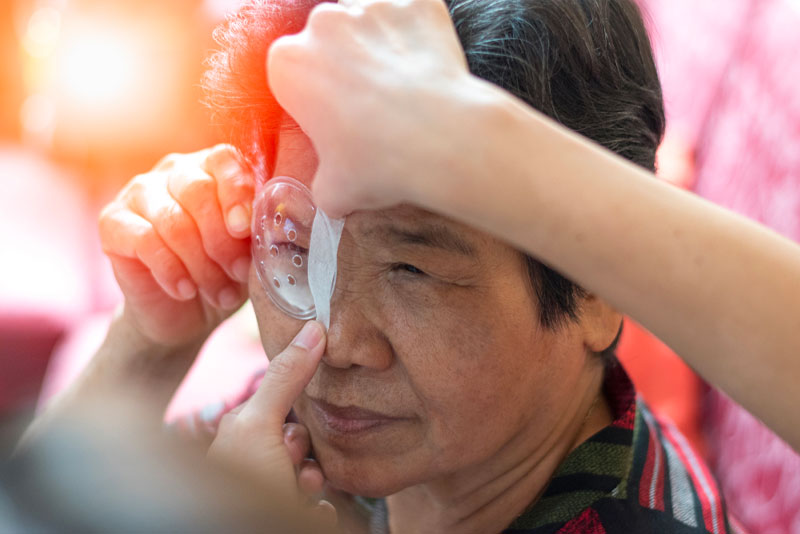 katarak-post Penyebab Katarak