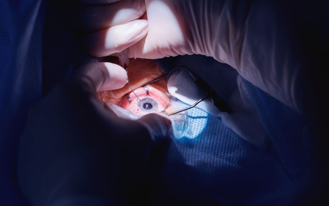 Persamaan Lasik Mata dan Operasi Katarak, Jangan Keliru!