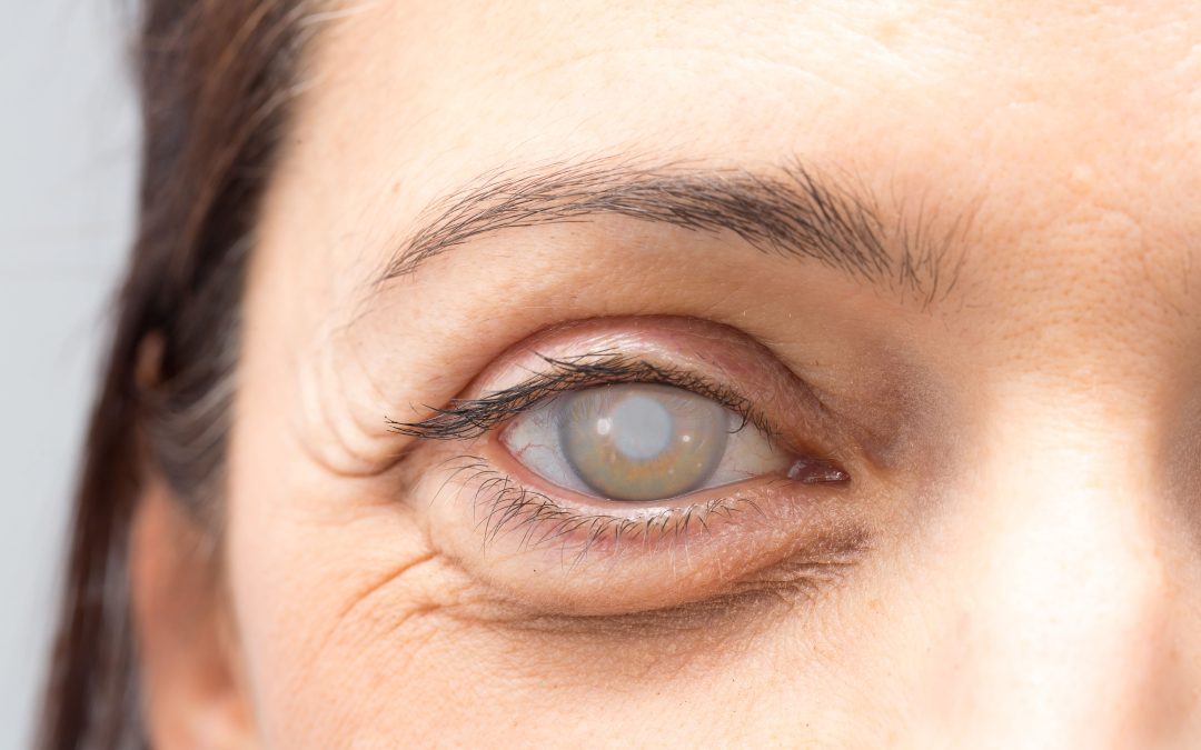 Katarak Diabetik, Komplikasi Diabetes pada Penglihatan